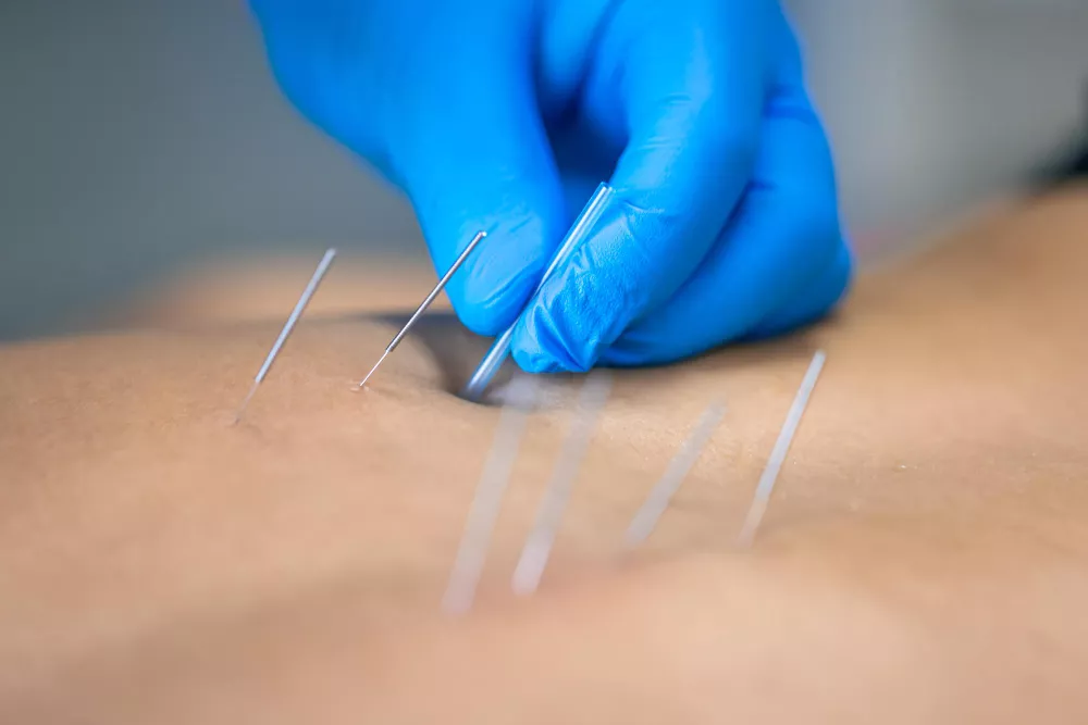 Dry Needling & Pain Management